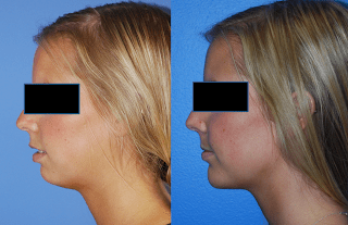 Adjustment of the Platysma Position and Chin Augmentation to Improve the Neck