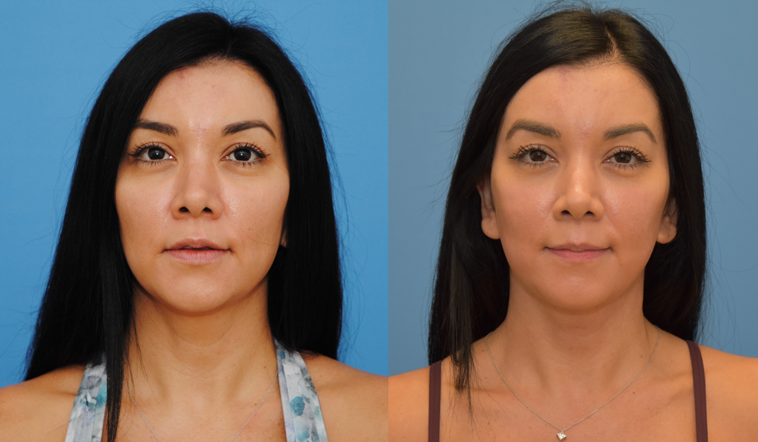 Lower Facelift and Neck-lift to Improve Neck, Jowl, and Jawline Contour