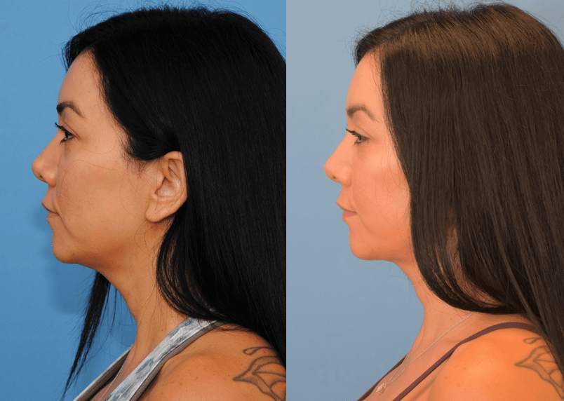 Necklift and Facelift