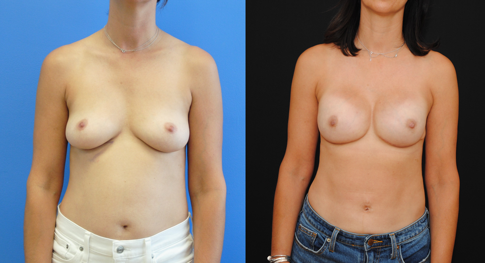 Bilateral Implant Reconstruction Following Mastectomy.