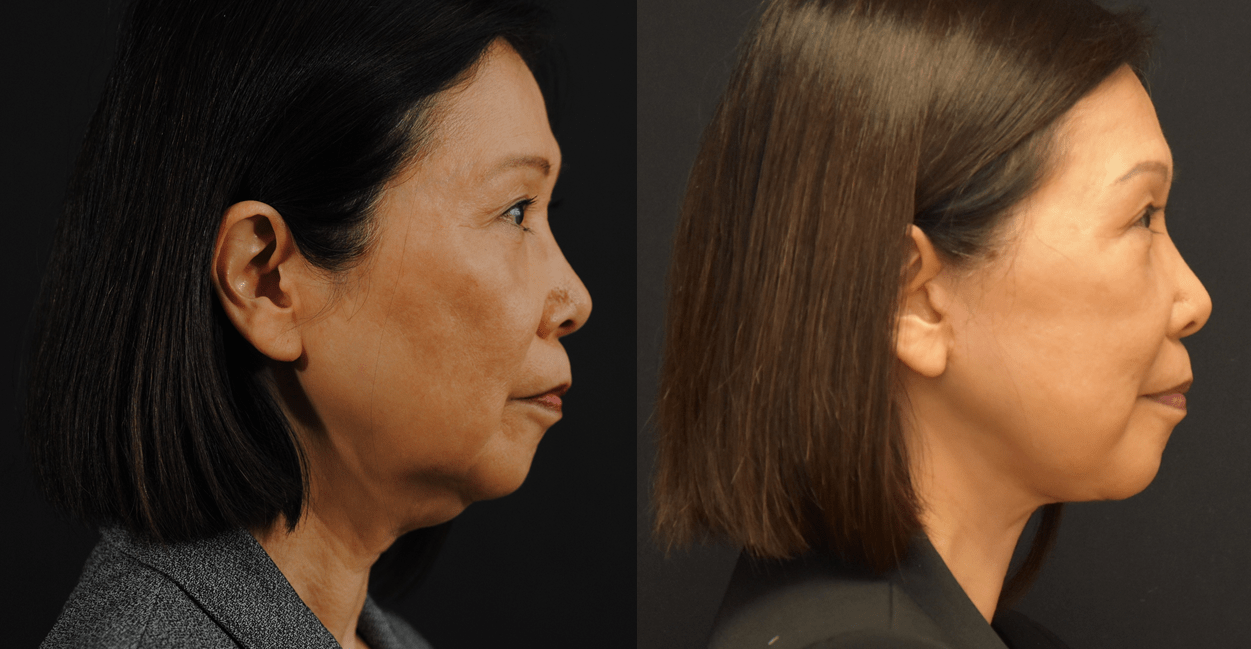 Lower Face and Necklift Side Profile