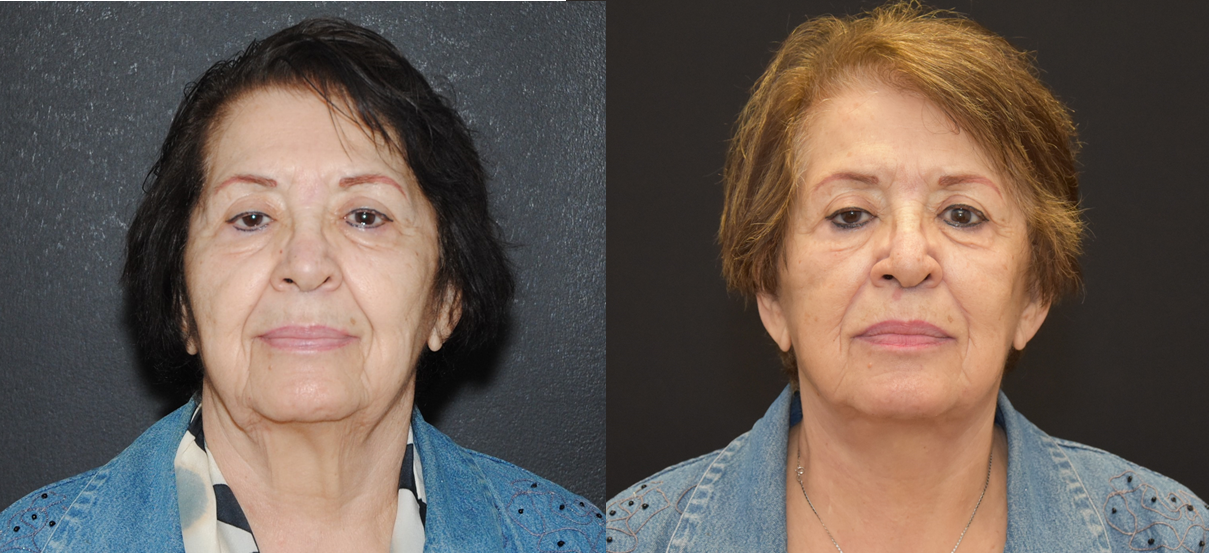 Facelift Surgery-Lower Face and Necklift