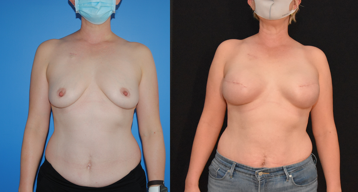 Mastectomy Breast Cancer Reconstruction- Implant Based Breast Reconstruction.