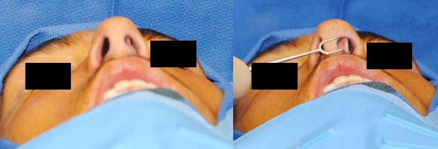 External Valve Nasal Airway Obstruction from Low Deviated Septum and Airway Reconstruction