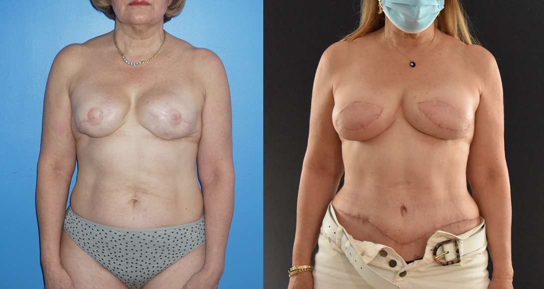 Breast Reconstruction- Removal of Bilateral Mammary Prosthesis and Bilateral DIEP Flap Breast Reconstruction