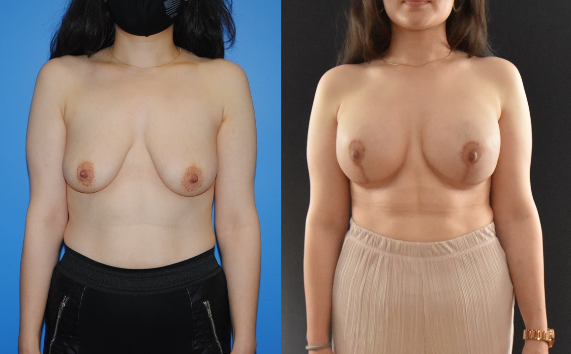 Bilateral Mastectomy Breast Reconstruction with Tissue Expanders and Implants