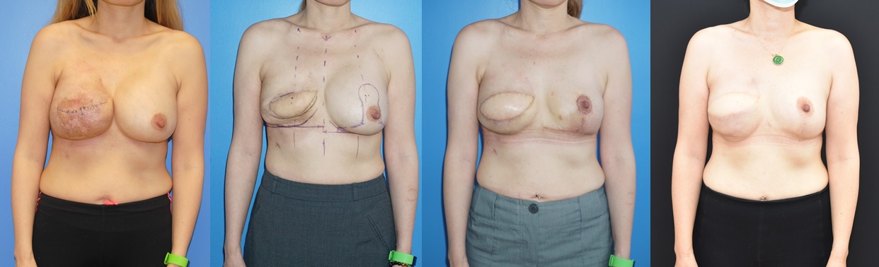 Image Progression shows reconstruction of an exposed mammary prosthesis