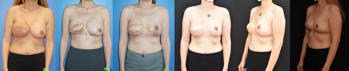 Image shows reconstruction of exposed mammary prosthesis with latissimus dorsi flap reconstruction