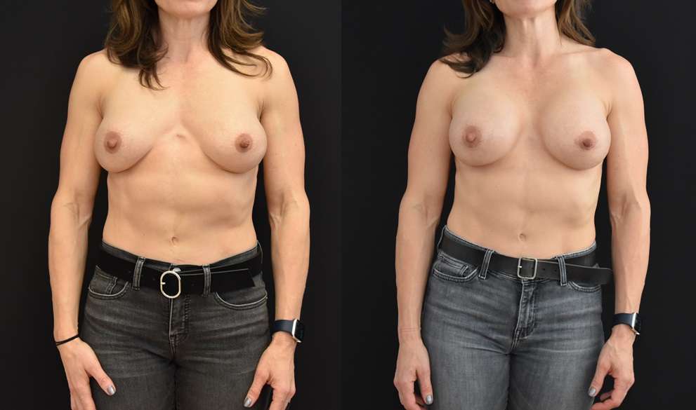 Secondary Breast Augmentation Procedures