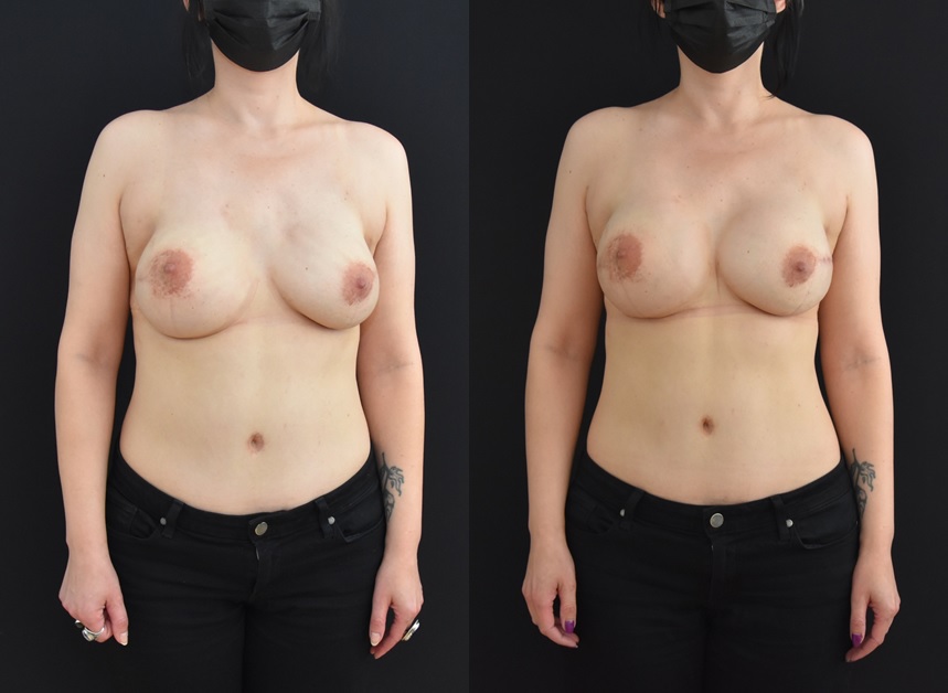 Secondary Mastectomy Reconstruction