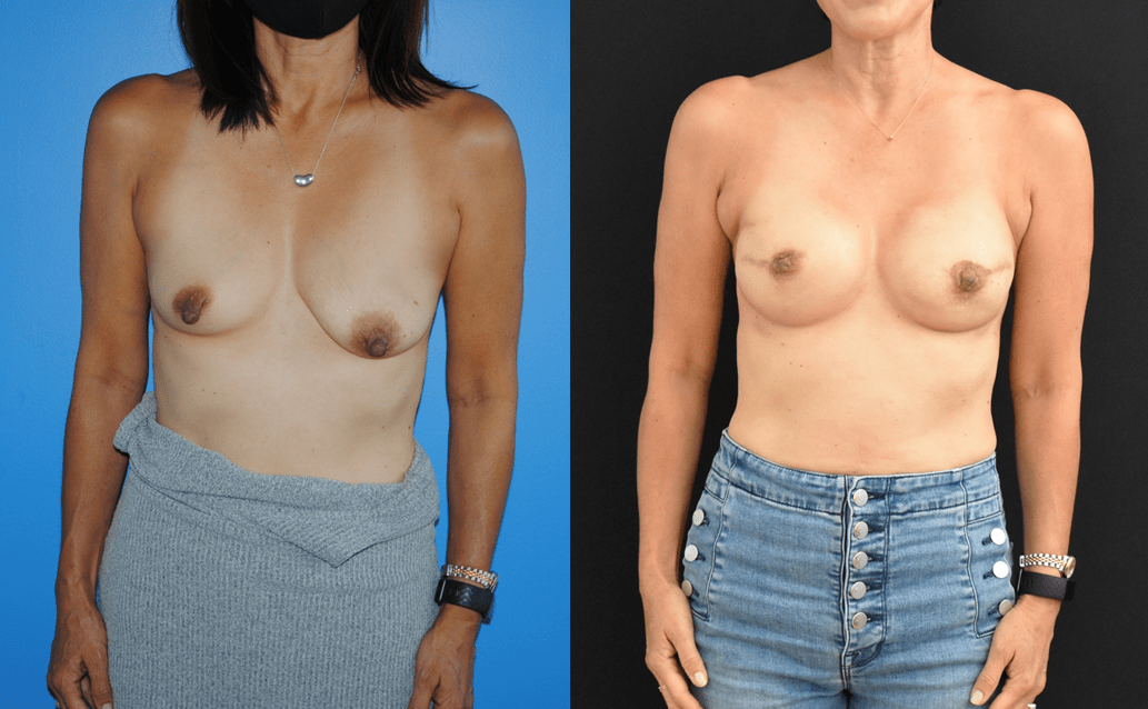 Bilateral Mastectomy Expander-Implant Breast Reconstruction.