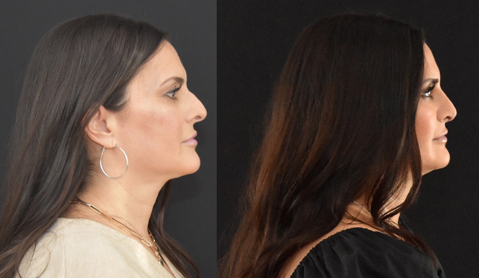 Rhinoplasty: My Favorite Operation. Decreasing Tip Projection and Defining the Nasal Tip