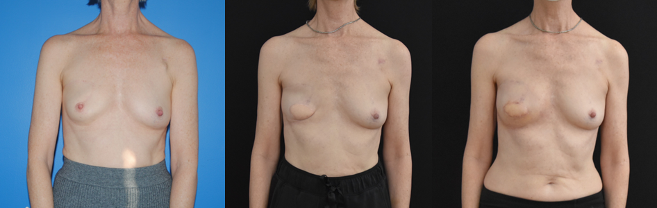 Latissimus Dorsi Flap Mastectomy Breast Reconstruction