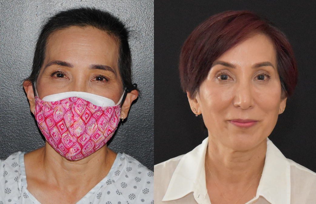Bilateral Upper Blepharoplasty for Facial Rejuvenation