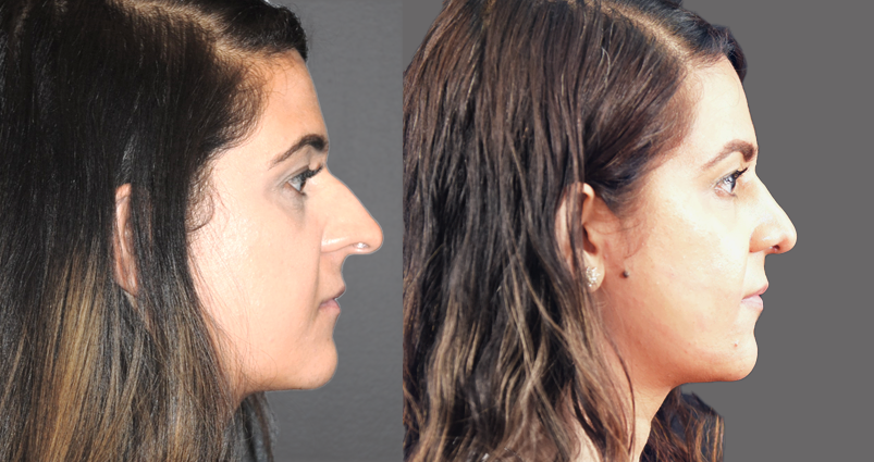 Rhinoplasty-Deprojection of the Nasal Tip- Early Post-Operative Results