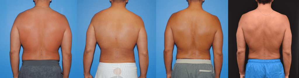 Liposuction Improves Over Two Years