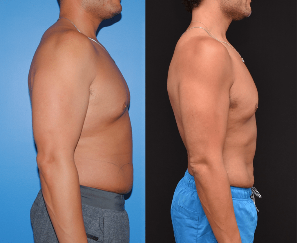 Flank & Back Liposuction