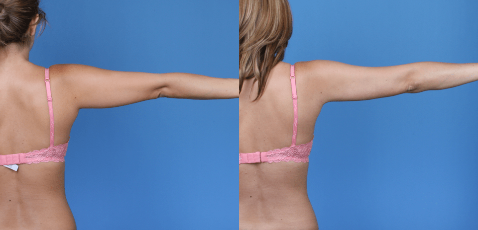 Arm Liposuction-A Helpful Tool to Sculpt the Body