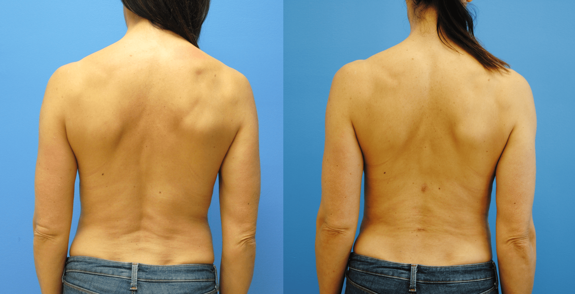 Lower Back Liposuction in Female Athletes. Liposuction of Flanks, Abdomen, Back, and Bra Fat-Circumferential Liposuction