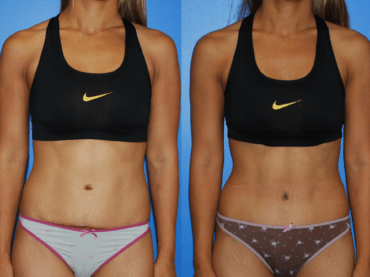 Abdominoplasty for a Narrow Waist