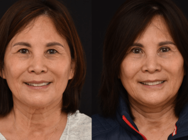 Bilateral Upper Blepharoplasty