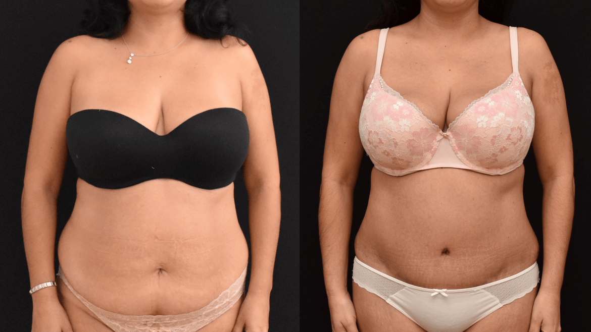 Abdominoplasty to Improve Body Contour and An Effective Weight Loss Management Kick Start.