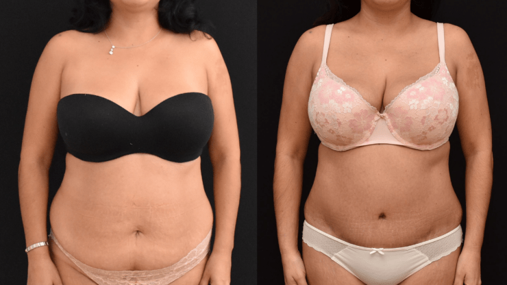 Abdominoplasty to Improve Body Contour and An Effective Weight Loss Management Kick Start.
