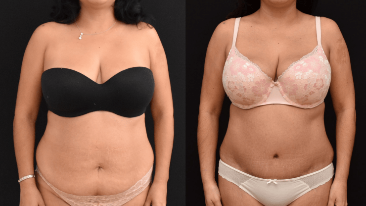 How does Abdominoplasty Work?