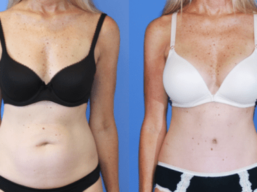 Abdominoplasty-Making the Waist Thinner.