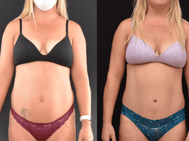 Abdominoplasty to Improve the Abdominal Contour and Make the Waistline Thinner