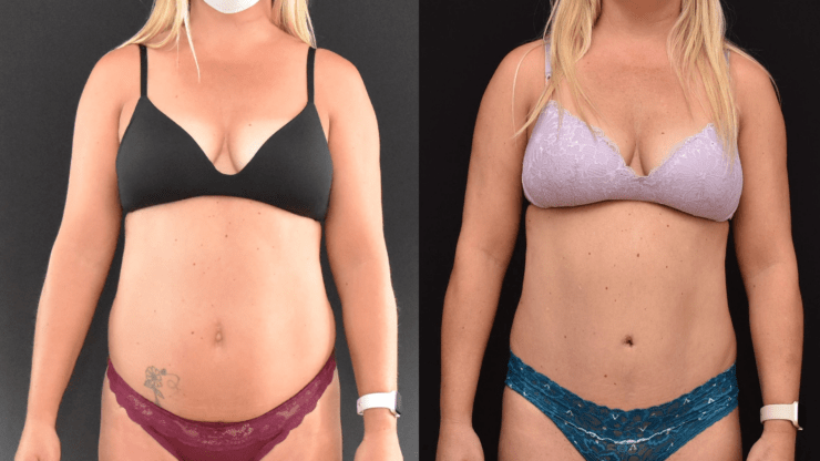 Abdominoplasty to Improve the Abdominal Contour and Make the Waistline Thinner