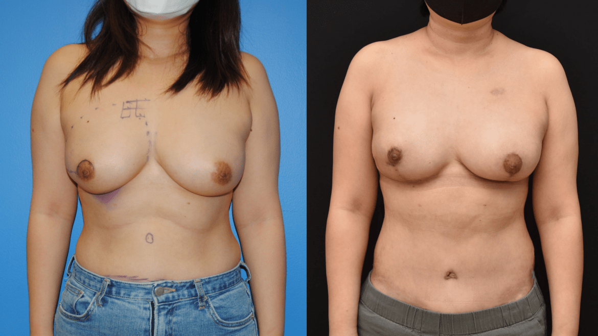 DIEP flap for Autologous Breast Reconstruction Following Mastectomy