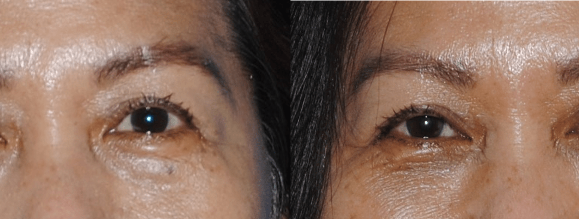 Lower Eyelid Blepharoplasty to Look Well Rested