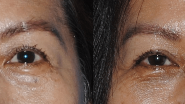 Lower Eyelid Blepharoplasty to Look Well Rested