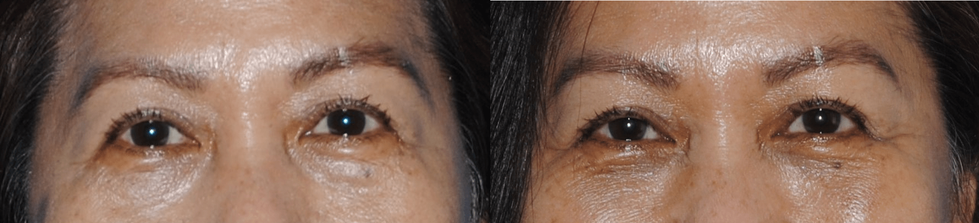 Before and After Lower Blepharoplasty for Facial Rejuvenation