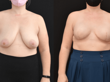 Mastectomy Breast Reconstruction with Tissue Expanders and Implants