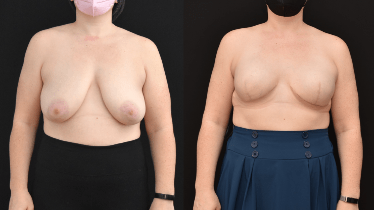 Mastectomy Breast Reconstruction with Tissue Expanders and Implants