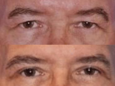 Upper Eyelid Blepharoplasty Surgery