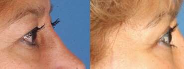 Upper and Lower Blepharoplasty for Youthful Appearing Eyes