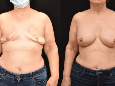 Implant Reconstruction following Bilateral Mastectomy