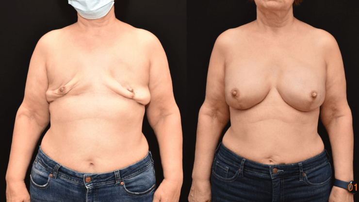 Implant Reconstruction following Bilateral Mastectomy