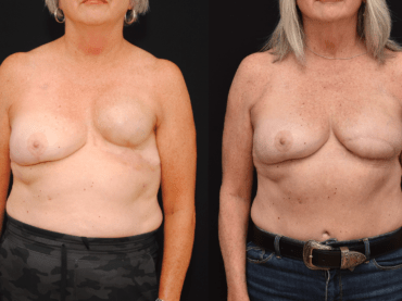 DIEP Flap Breast Reconstruction