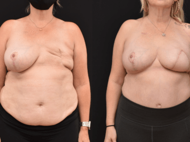 Left Breast Reconstruction with DIEP Flap to Reconstruct the Breasts when Implants are not an Option