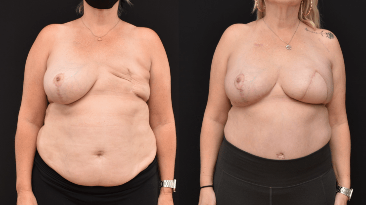 Left Breast Reconstruction with DIEP Flap to Reconstruct the Breasts when Implants are not an Option