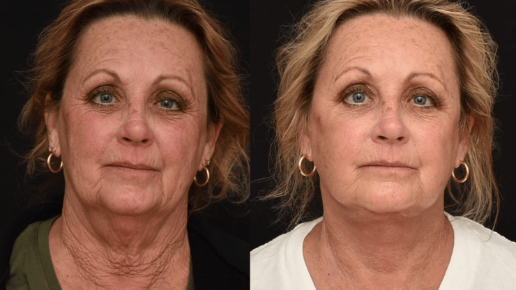 Lower Face and Neck Lift Surgery for Facial Rejuvenation.