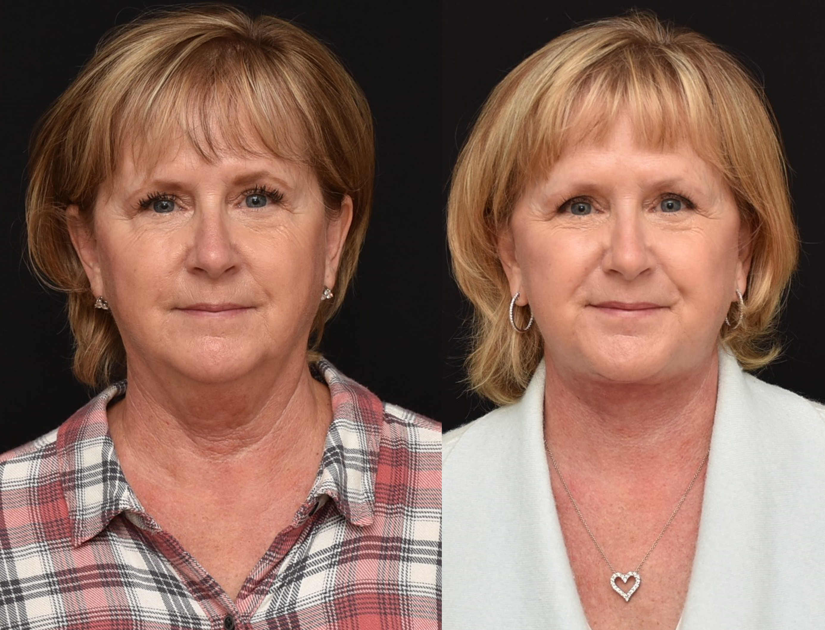 Photograph demonstrating before and after lower face and neck lift.