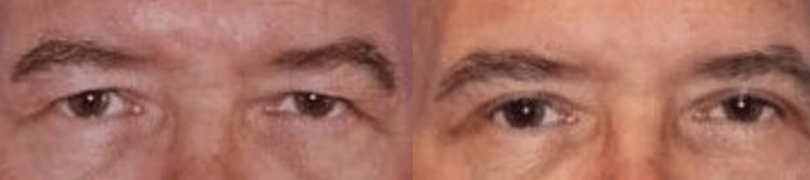 Male Before & After Upper Eyelid Blepharoplasty