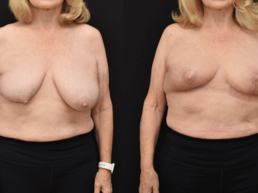 Oncoplastic Reconstruction of Lumpectomy Defect 20 years Post-Radiation