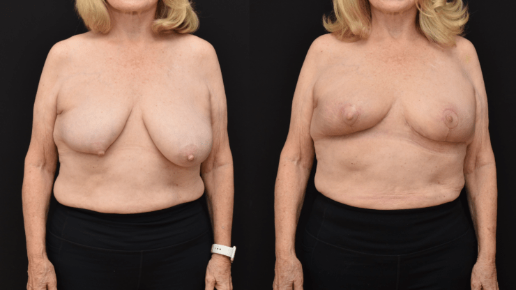 Oncoplastic Reconstruction of Lumpectomy Defect 20 years Post-Radiation