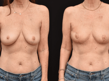 Oncoplastic Reconstruction of Lumpectomy Defects